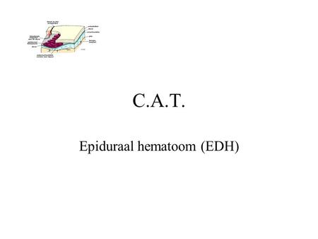 Epiduraal hematoom (EDH)