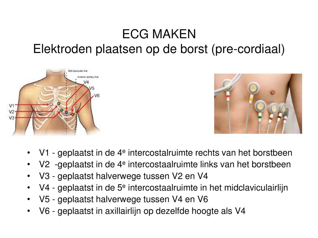 ECG MAKEN Elektroden plaatsen op de borst (pre-cordiaal)