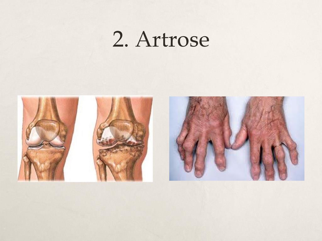 2. Artrose