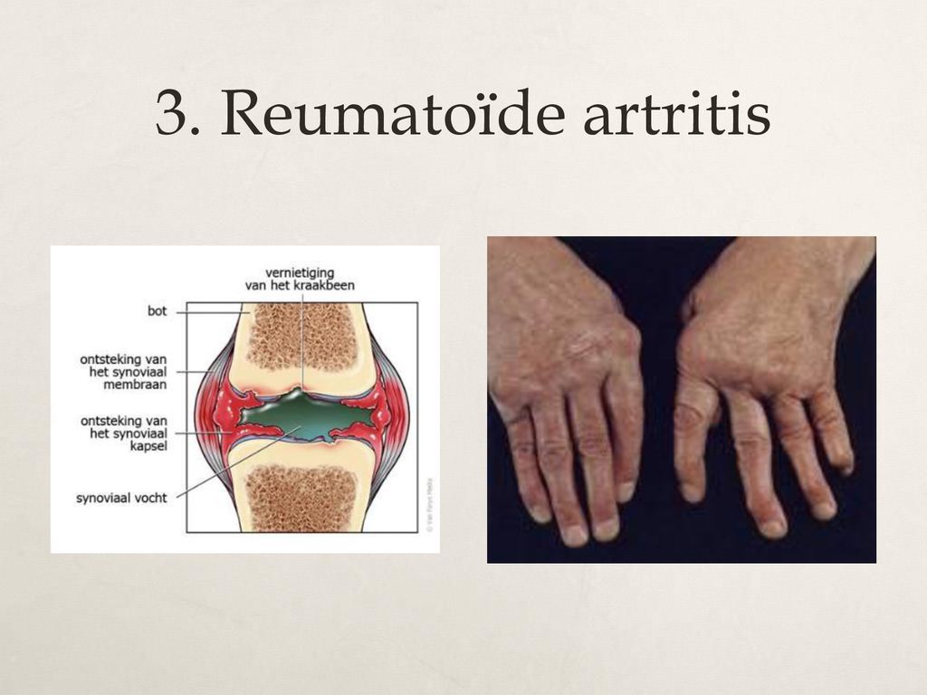 3. Reumatoïde artritis
