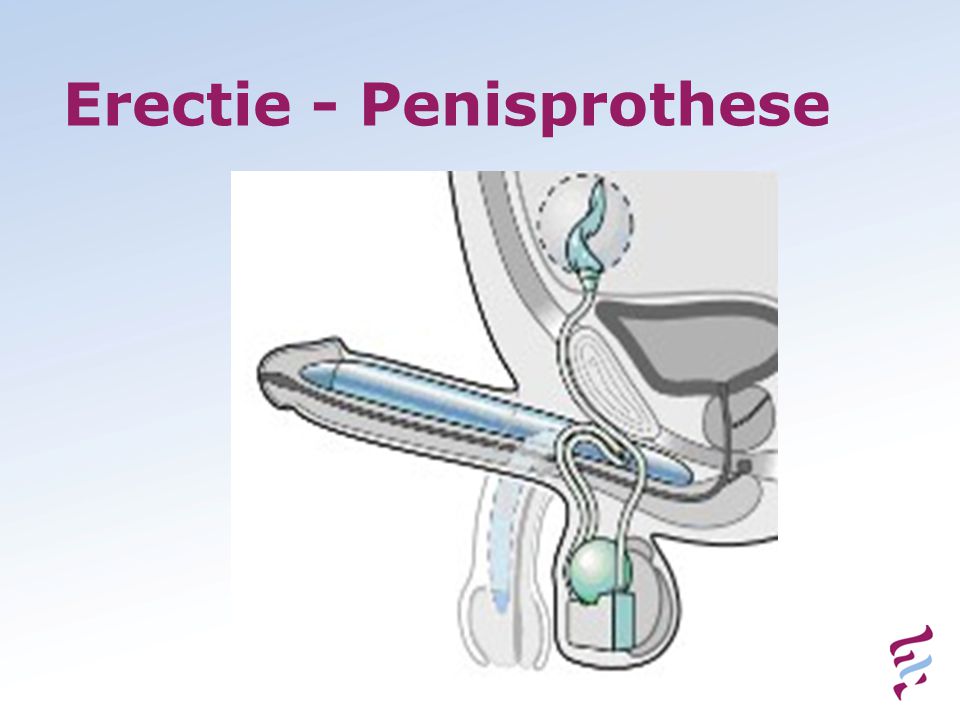 Erectie - Penisprothese