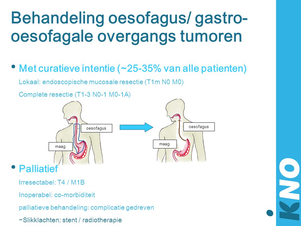 Behandeling oesofagus/ gastro-oesofagale overgangs tumoren