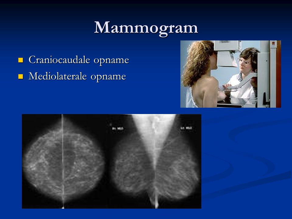 Mammogram Craniocaudale opname Mediolaterale opname