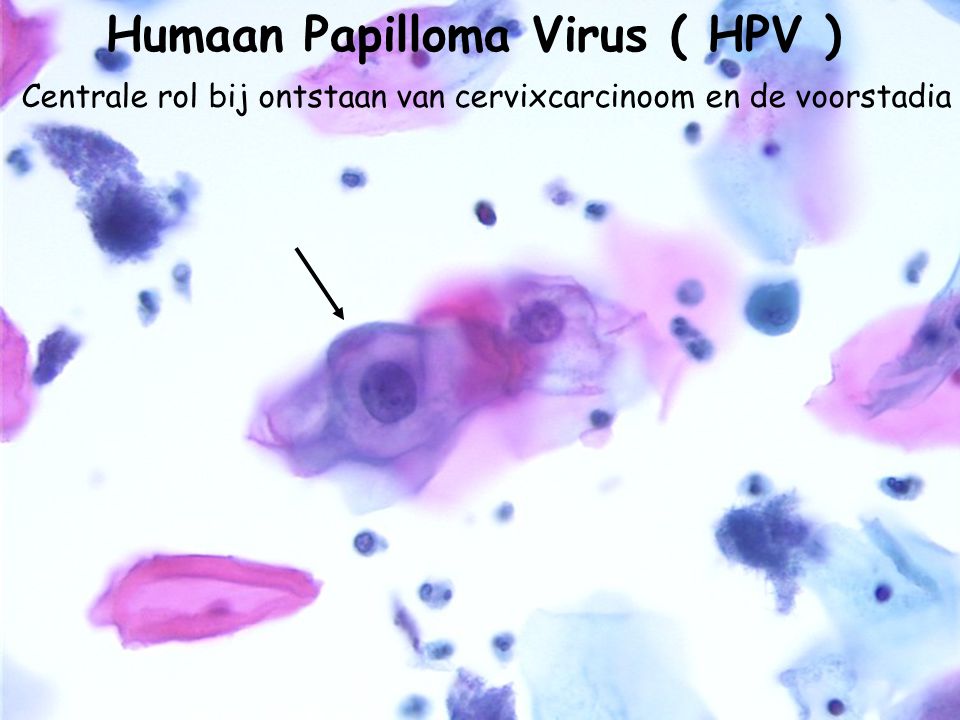 Humaan Papilloma Virus ( HPV )