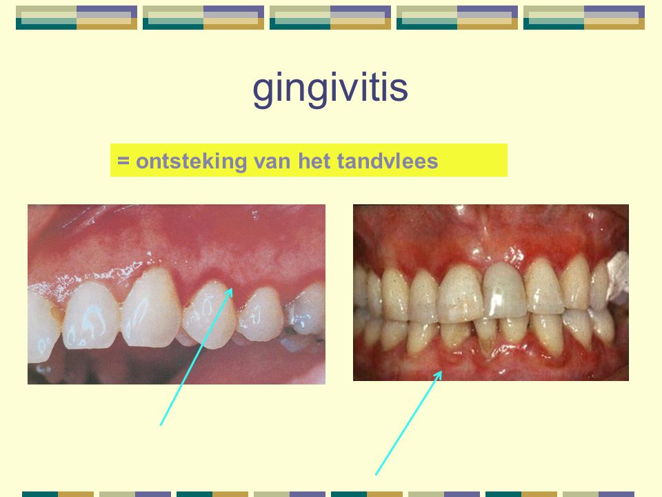 gingivitis = ontsteking van het tandvlees