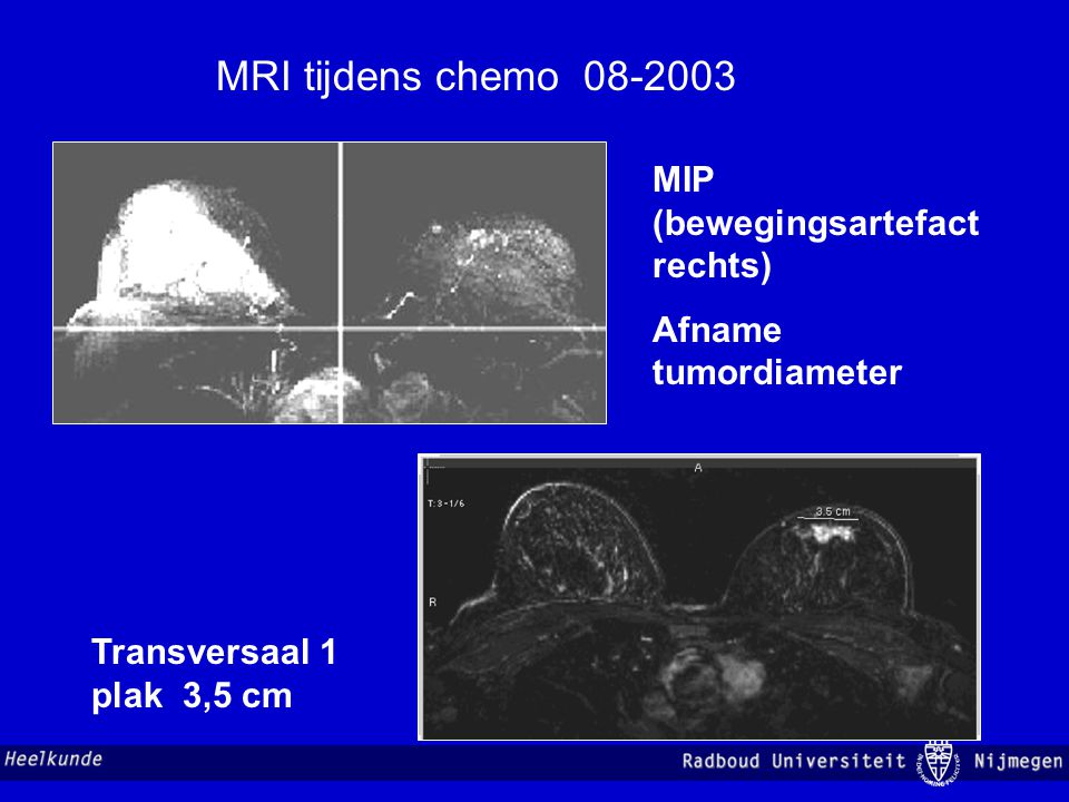 MRI tijdens chemo MIP (bewegingsartefact rechts)
