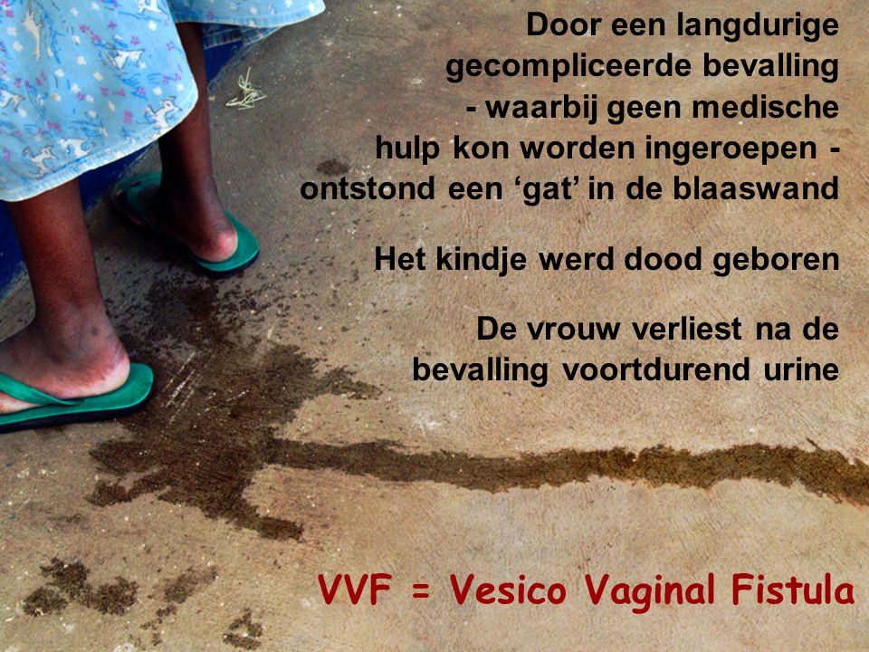 VVF = Vesico Vaginal Fistula