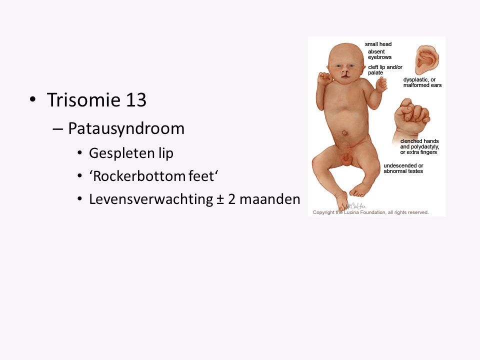 Trisomie 13 Patausyndroom Gespleten lip ‘Rockerbottom feet‘
