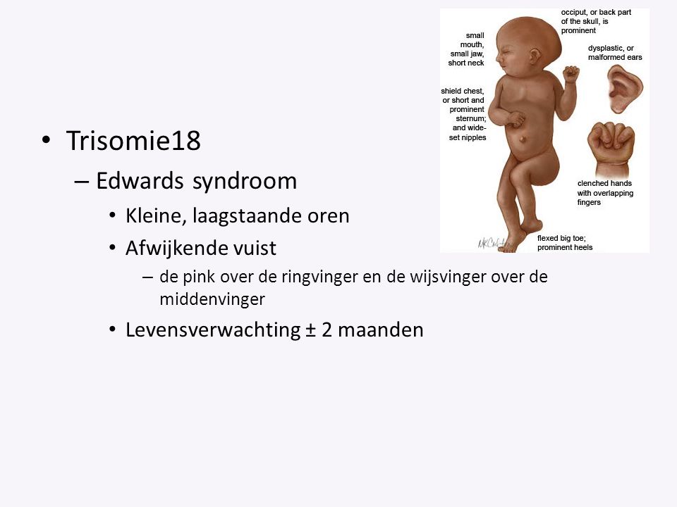Trisomie18 Edwards syndroom Kleine, laagstaande oren Afwijkende vuist