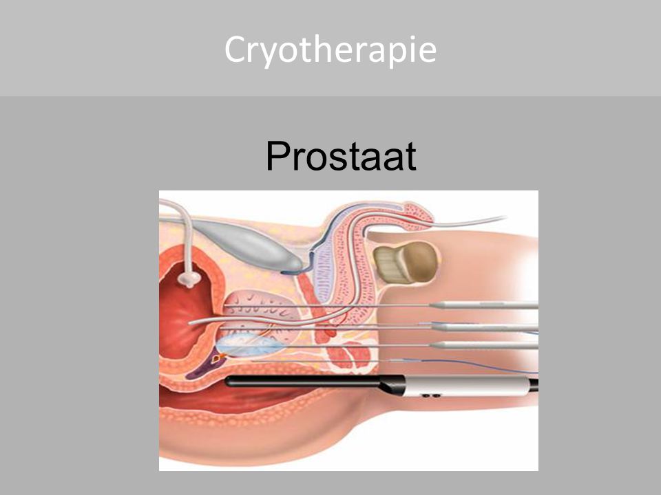 Cryotherapie Prostaat