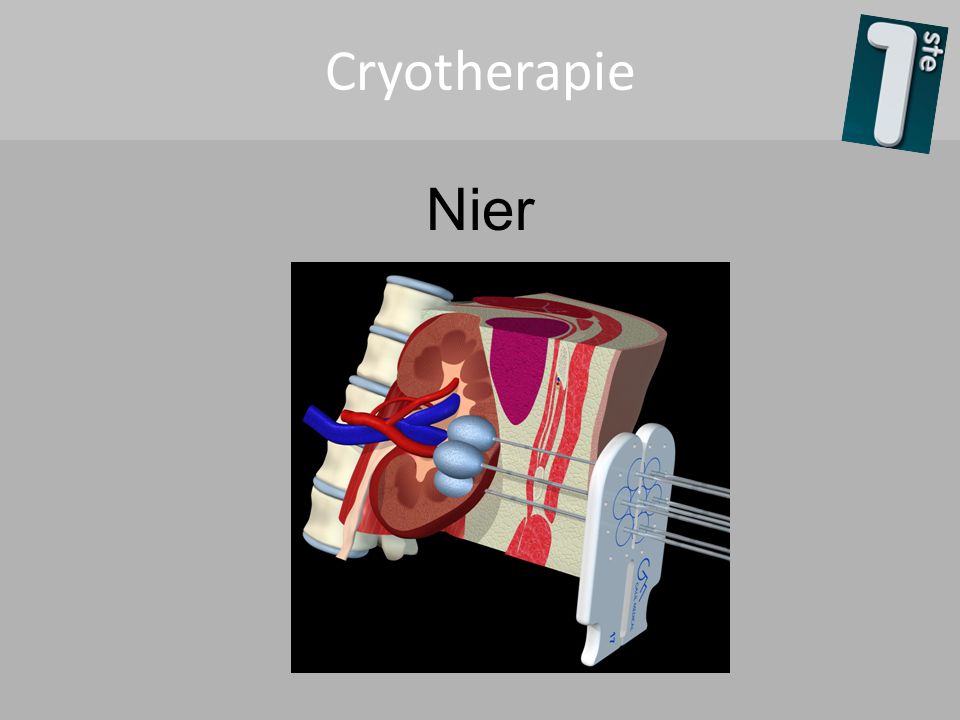 Cryotherapie Nier