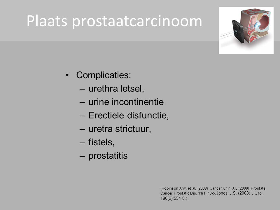 Cryotherapy Plaats prostaatcarcinoom Complicaties: urethra letsel,