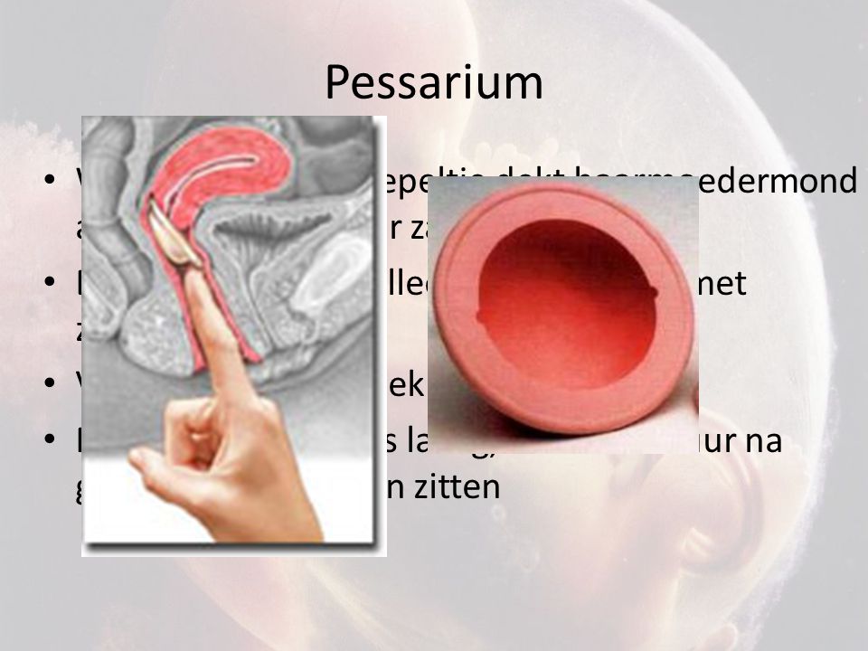 Pessarium Werking: rubber koepeltje dekt baarmoedermond af, onberijkbaar voor zaadcellen. Betrouwbaarheid: alleen betrouwbaar met zaaddodend middel.