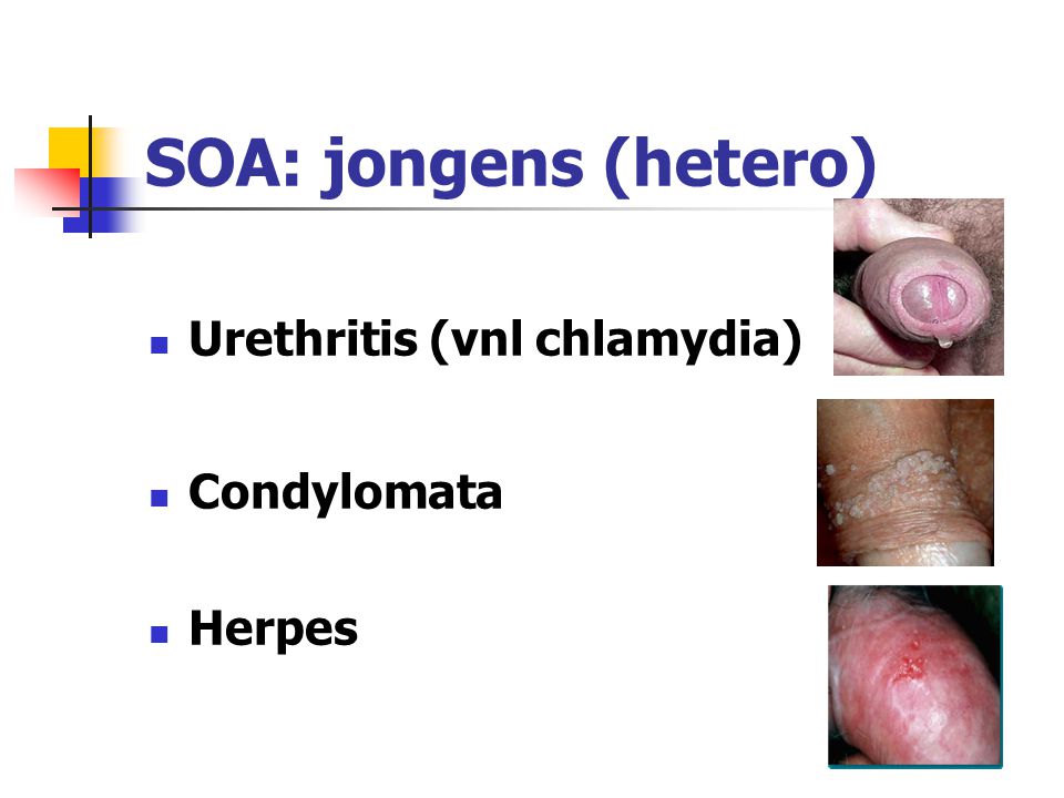 SOA: jongens (hetero) Urethritis (vnl chlamydia) Condylomata Herpes
