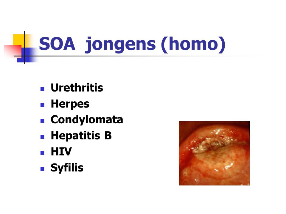 SOA jongens (homo) Urethritis Herpes Condylomata Hepatitis B HIV