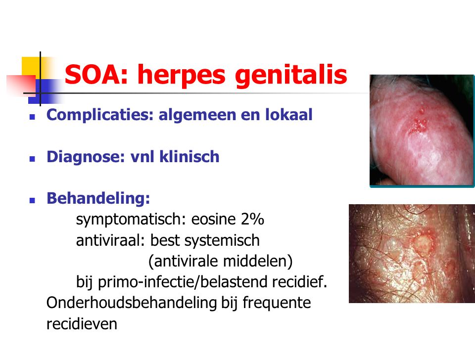 SOA: herpes genitalis Complicaties: algemeen en lokaal