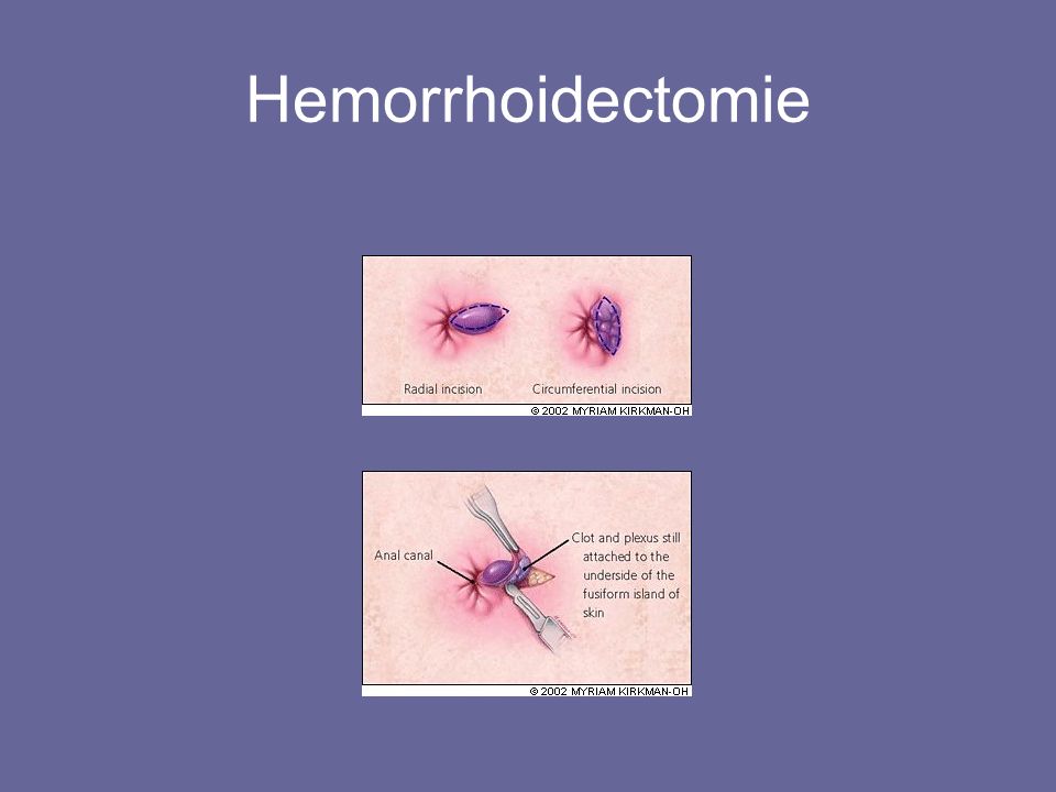 Hemorrhoidectomie