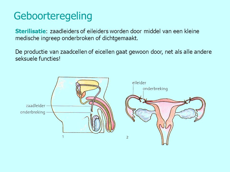 Geboorteregeling Sterilisatie: zaadleiders of eileiders worden door middel van een kleine medische ingreep onderbroken of dichtgemaakt.