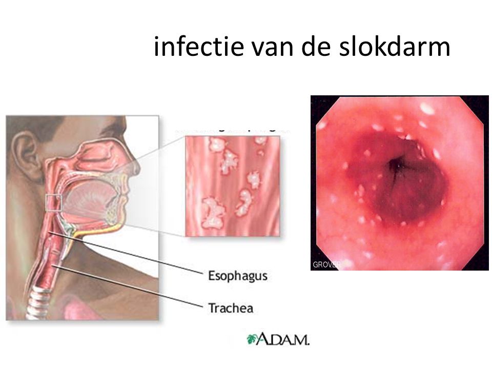 Candidia infectie van de slokdarm