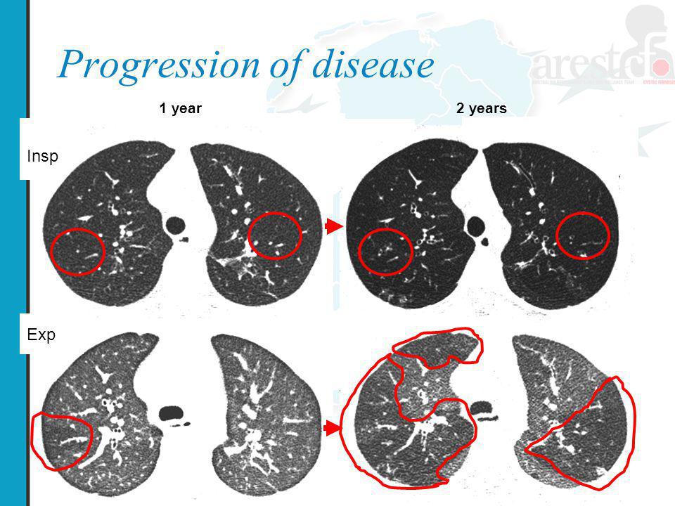 Progression of disease