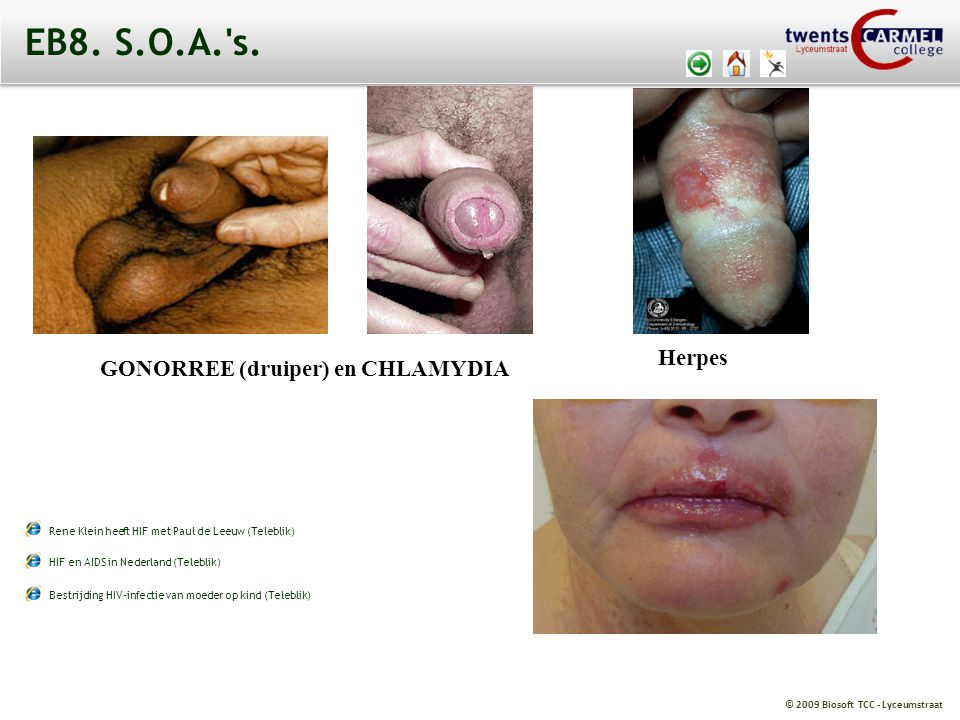 EB8. S.O.A. s. Herpes GONORREE (druiper) en CHLAMYDIA
