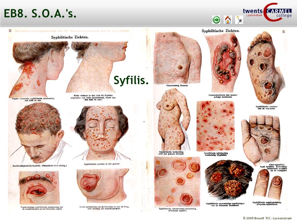 EB8. S.O.A. s. Syfilis.