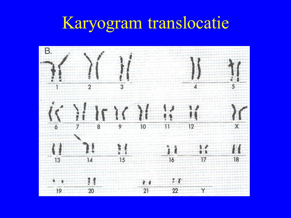 Karyogram translocatie