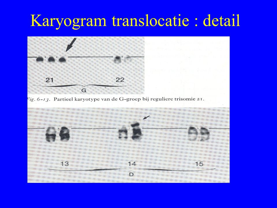 Karyogram translocatie : detail