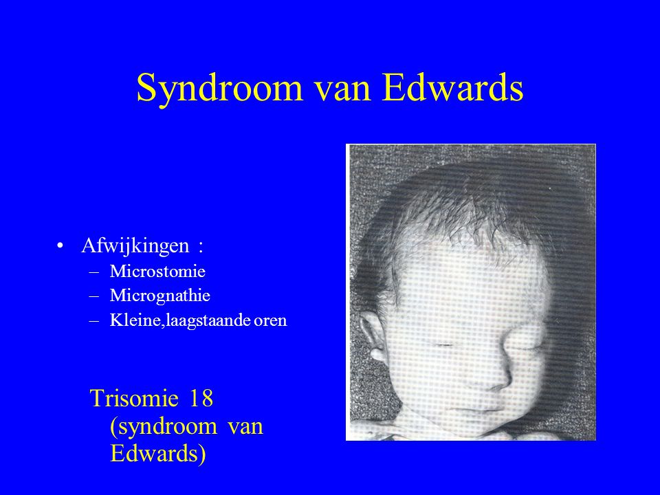 Syndroom van Edwards Trisomie 18 (syndroom van Edwards) Afwijkingen :