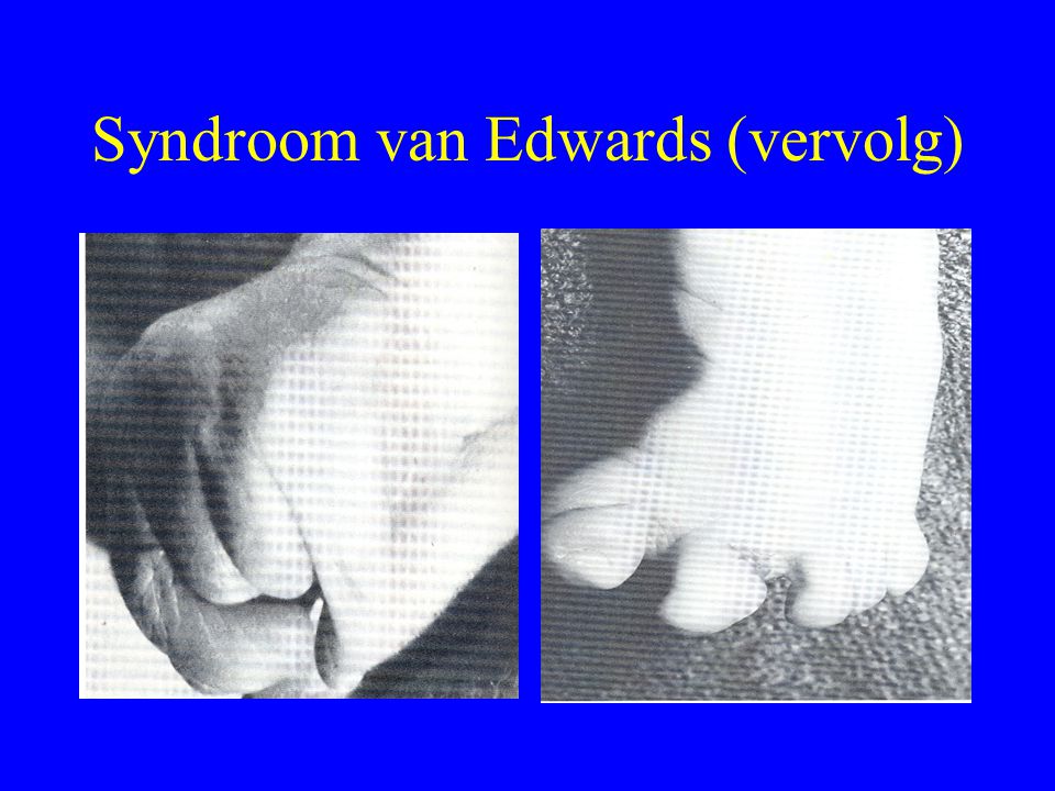 Syndroom van Edwards (vervolg)
