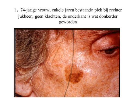 1. 74-jarige vrouw, enkele jaren bestaande plek bij rechter jukbeen, geen klachten, de onderkant is wat donkerder geworden.