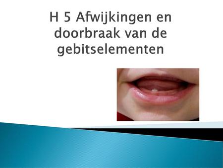 H 5 Afwijkingen en doorbraak van de gebitselementen