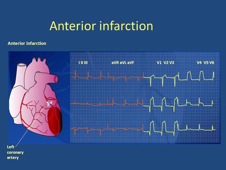 Anterior infarction Anterior infarction I II III aVR aVL aVF V1 V2 V3