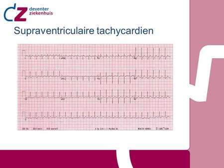 Supraventriculaire tachycardien