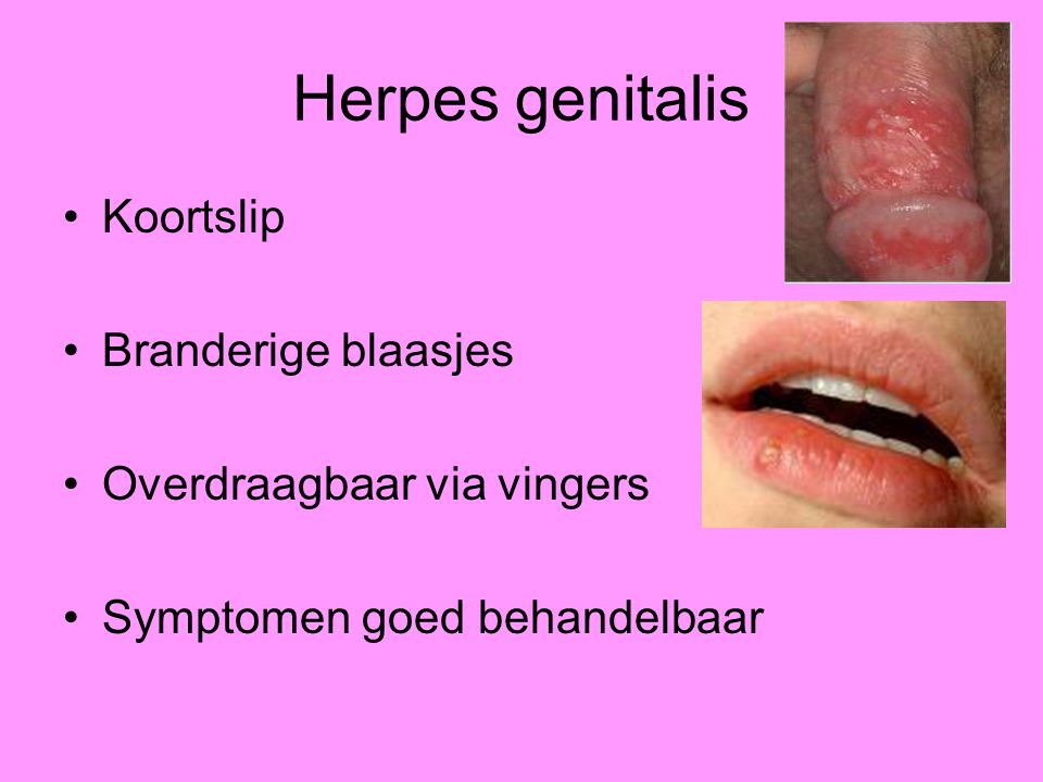 Herpes genitalis Koortslip Branderige blaasjes.