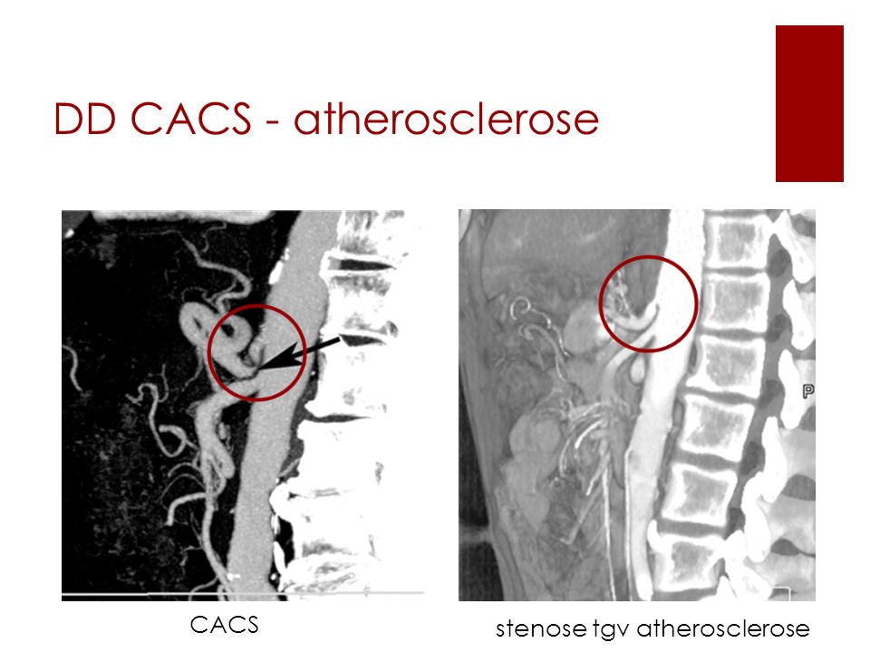 DD CACS - atherosclerose
