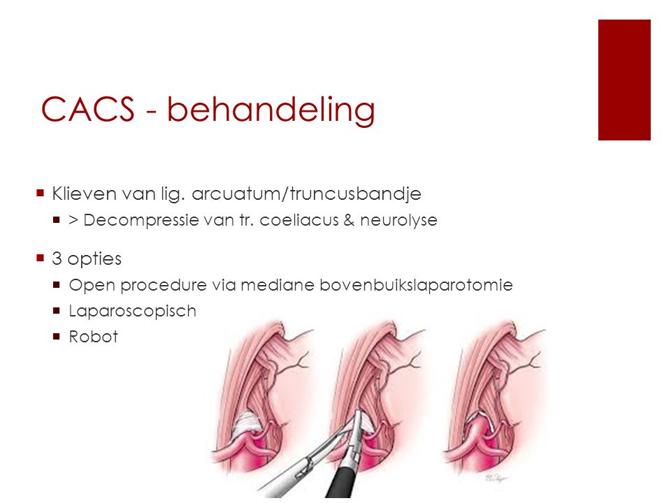 CACS - behandeling Klieven van lig. arcuatum/truncusbandje 3 opties