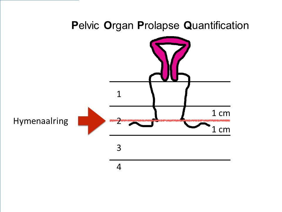 Pelvic Organ Prolapse Quantification
