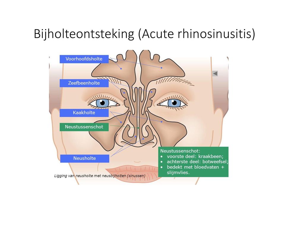 Bijholteontsteking (Acute rhinosinusitis)