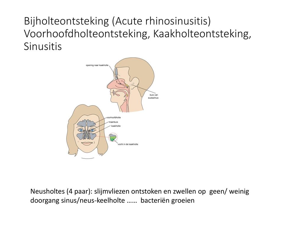 Bijholteontsteking (Acute rhinosinusitis) Voorhoofdholteontsteking, Kaakholteontsteking, Sinusitis