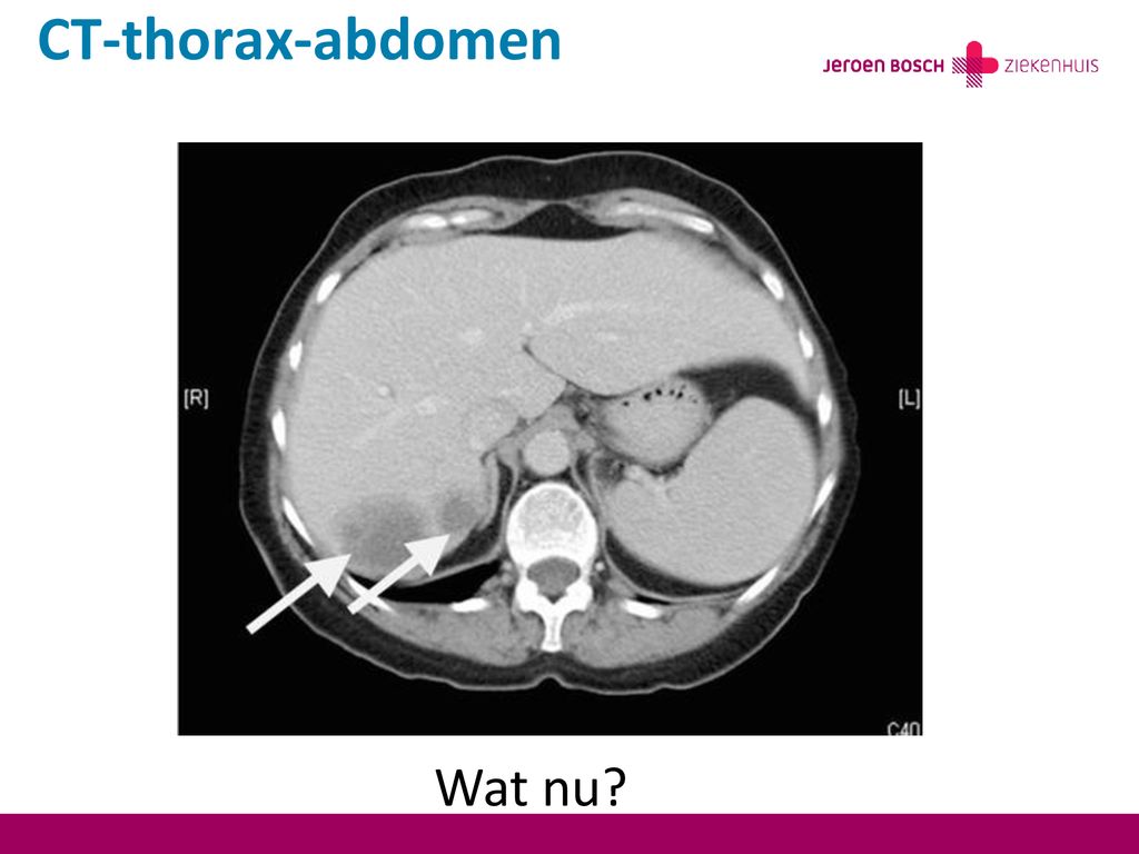 CT-thorax-abdomen Wat nu