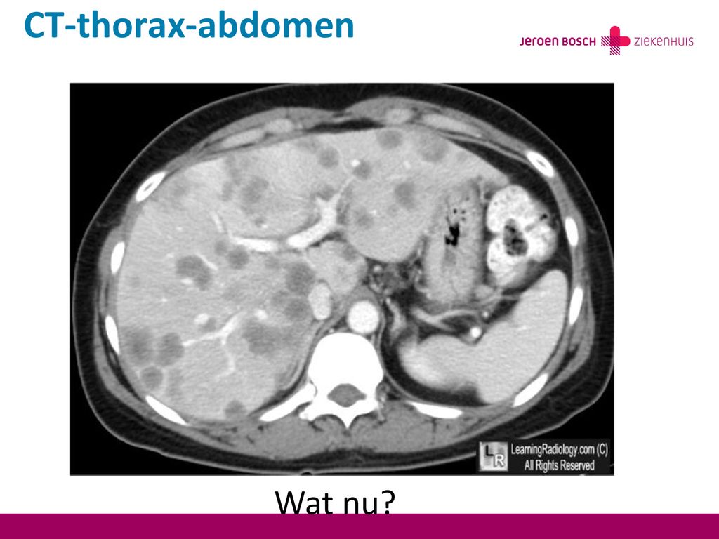 CT-thorax-abdomen Wat nu