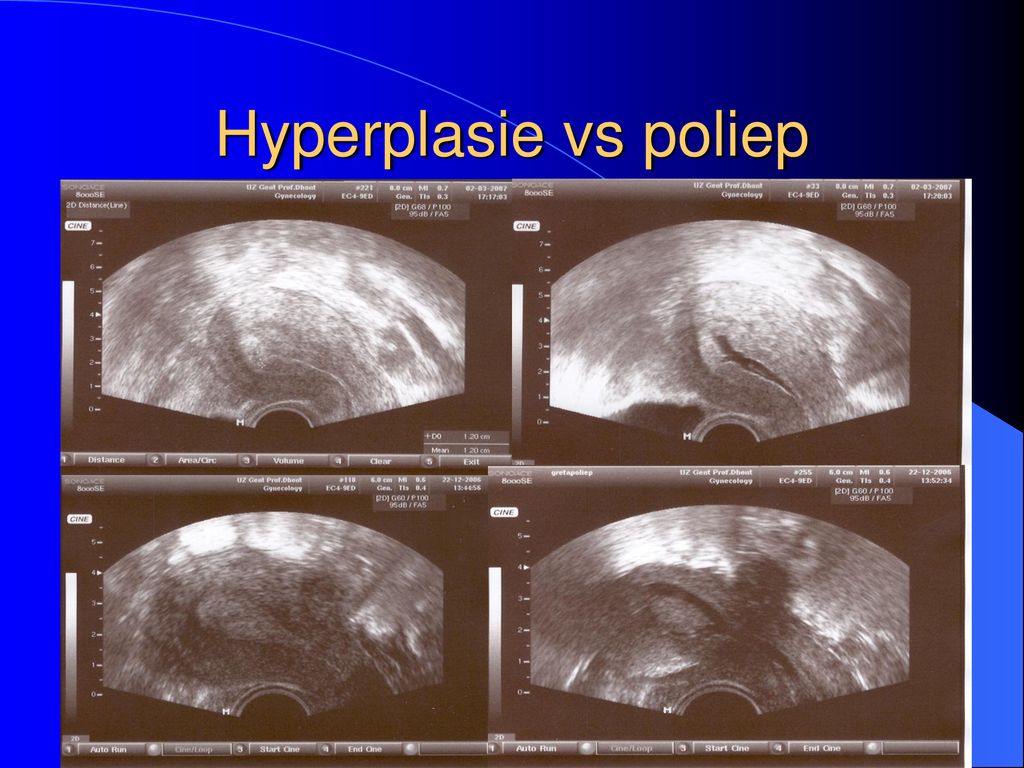 Hyperplasie vs poliep Ter Elst, Edegem 24 mei, 2007