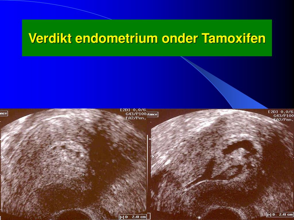 Verdikt endometrium onder Tamoxifen
