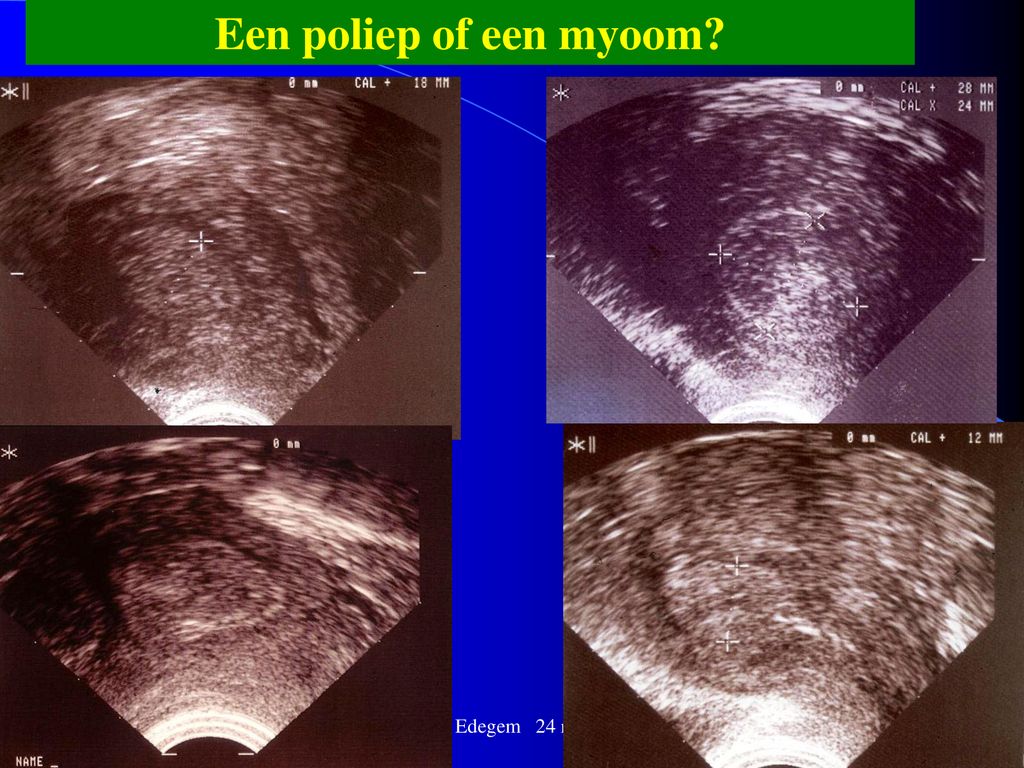 Een poliep of een myoom Ter Elst, Edegem 24 mei, 2007
