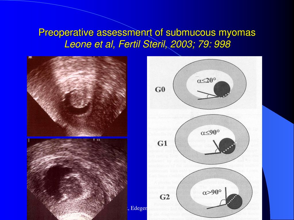 Preoperative assessmenrt of submucous myomas Leone et al, Fertil Steril, 2003; 79: 998
