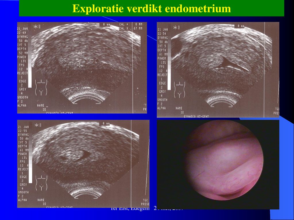Exploratie verdikt endometrium