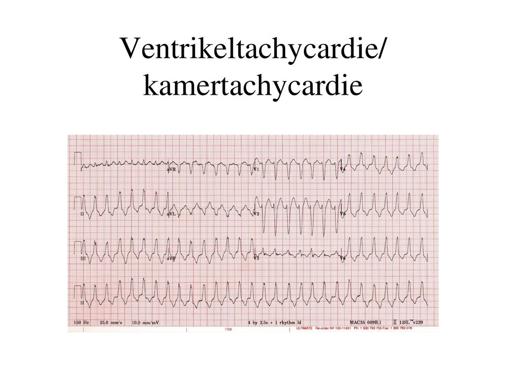 Ventrikeltachycardie/ kamertachycardie