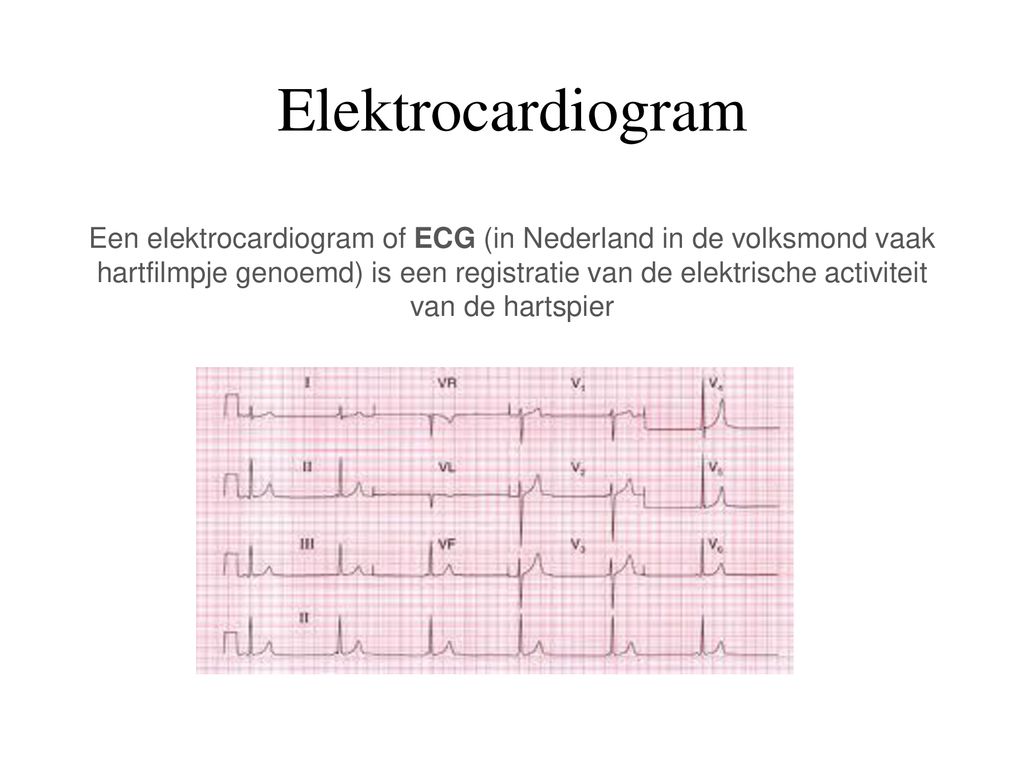 Elektrocardiogram Een elektrocardiogram of ECG (in Nederland in de volksmond vaak hartfilmpje genoemd) is een registratie van de elektrische activiteit van de hartspier