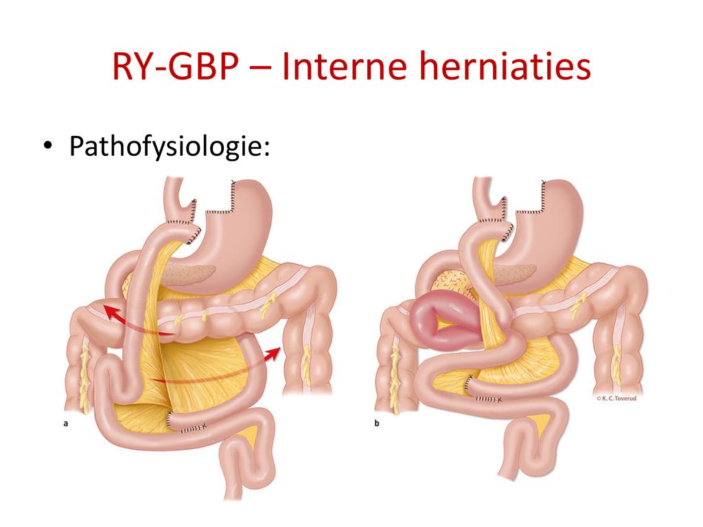 RY-GBP – Interne herniaties